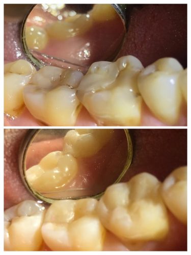 ¿El tratamiento dental más barato?