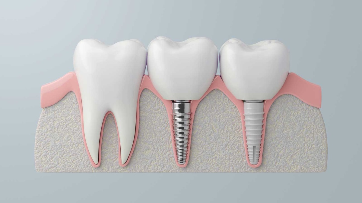 Implantes dentales en Sitges Implantes dentales en Sitges