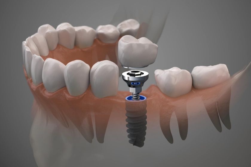 dental implant